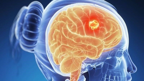 Triệu chứng thần kinh não