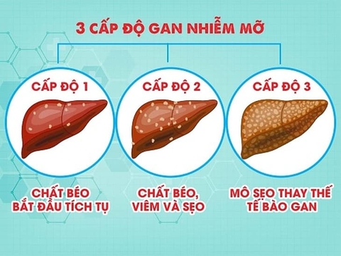 3 cấp độ gan nhiễm mỡ