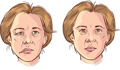 dấu hiệu đột quỵ