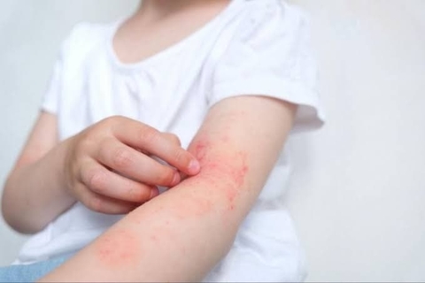 Dấu hiệu nóng trong người