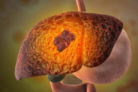 Hemangioma gan