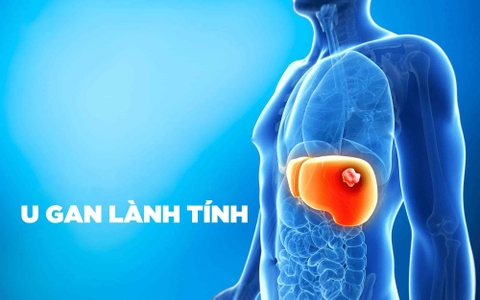 u gan lành tính 