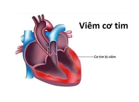 Viêm cơ tim là gì