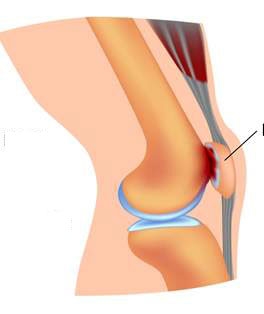 Hội Chứng Chè Đùi (Patellofemoral Pain Syndrome)
