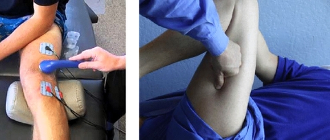 Giai đoạn cấp, Xử trí đau viêm:  Chườm lạnh, Siêu âm trị liệu, Điện trị liệu, Kỹ thuật Trigger poin