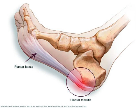 Viêm cân gan chân (Plantar fasciitis)
