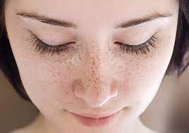 Bật mí cho bạn 7 bí quyết điều trị nám da an toàn và nhanh chóng tại nhà