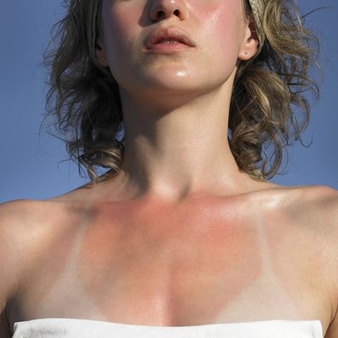 Sạm da do cháy nắng và cách phục hồi