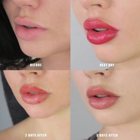 Kismet Stem Cell For Lips giảm mụn nước sau phun xăm môi