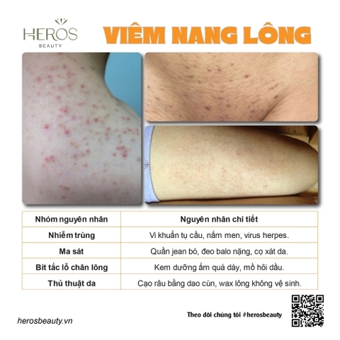 Bạn có biết có nhiều nguyên nhân dẫn tới tình trạng viêm nang lông?