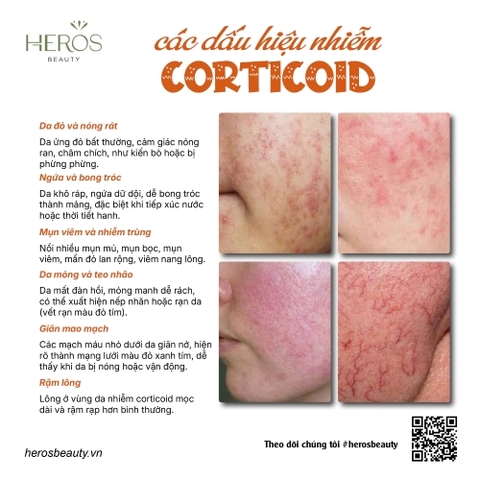 Các dấu hiệu nhận biết bị nhiễm corticoid