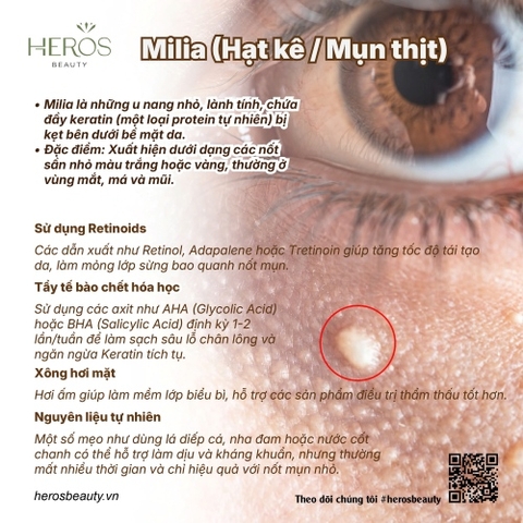 Các hạt trắng trên da còn gọi là milia gây mất thẩm mỹ có thể xử lý được