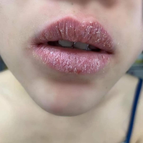 Dị ứng mực xăm là gì?