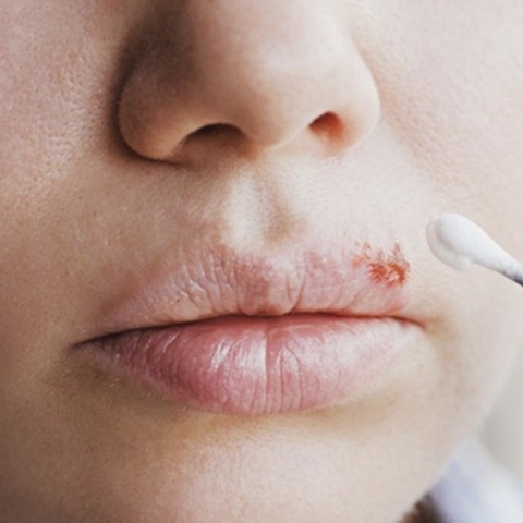 Mụn rộp môi - Nguyên nhân và biểu hiện phổ biến