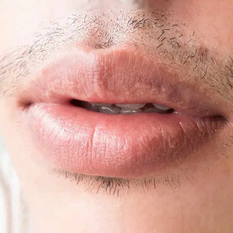 HẠT FORDYCE TRÊN MÔI, NGUYÊN NHÂN VÀ CÁCH ĐIỀU TRỊ