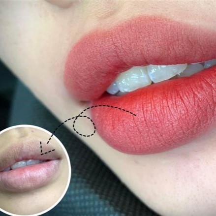 Điểm mặt các công nghệ khử thâm môi mới nhất