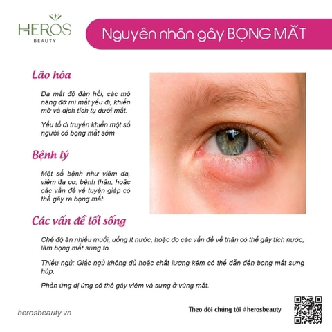 Nguyên nhân gây bọng mắt và bí quyết giúp cải thiện hiệu quả