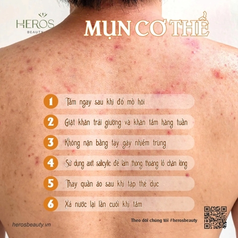 Những điều cần lưu ý khi bạn bị mụn cơ thể