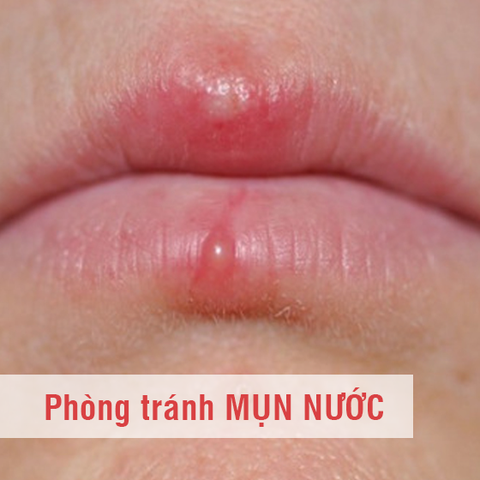 Phòng tránh mụn nước sau phun môi như thế nào?
