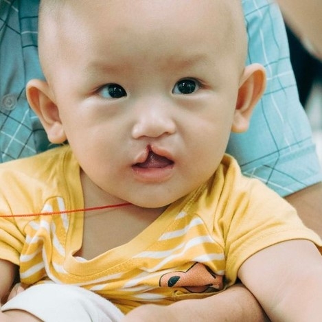 CAN THIỆP THẨM MỸ TỪ SỚM CHO TRẺ DỊ TẬT MÔI