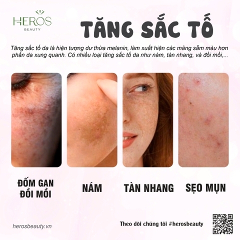 PHÂN LOẠI TĂNG SẮC TỐ DA VÀ GIẢI PHÁP GIÚP CHĂM SÓC DA HIỆU QUẢ