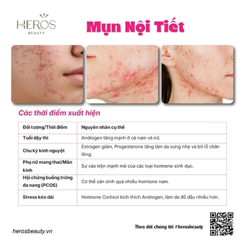 Các thời điểm xuất hiện mụn nội tiết