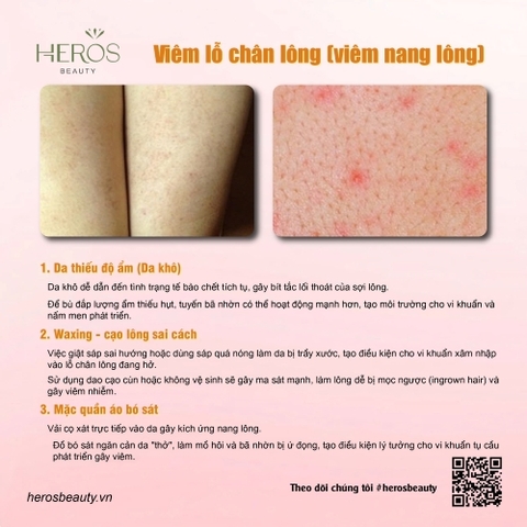 Nguyên nhân gây viêm lỗ chân lông và giải pháp cải thiện hiệu quả