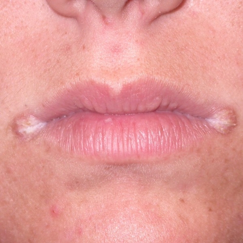 VIÊM MÉP NỨT KHÓE MÔI, NGUYÊN NHÂN VÀ CÁCH ĐIỀU TRỊ