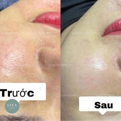 [INNOAESTHETICS] Peel Da Chống Lão Hoá, Làm Sáng Da T.C. AGE Inno-Exfo