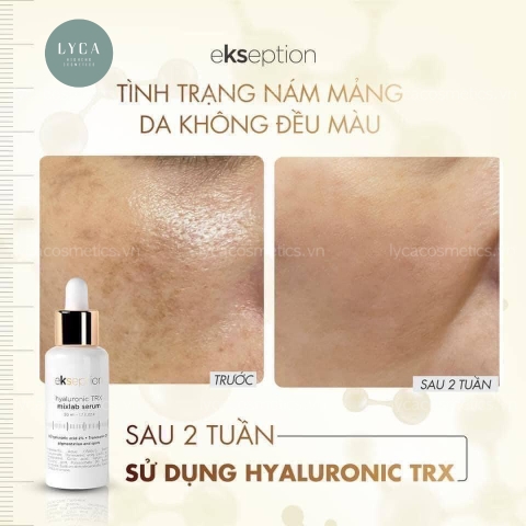 [EKSEPTION] tinh chất mờ thâm sáng da Hyaluronic Niacin và tinh chất giảm nám, mờ thâm Hyaluronic TRX