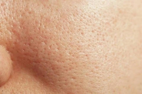NGUYÊN NHÂN LÀM TO LỖ CHÂN LÔNG VÀ CÁC KHẮC PHỤC .
