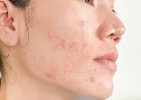 NGUYÊN NHÂN GÂY SẸO RỖ SAU KHI BỊ VIÊM MỤN