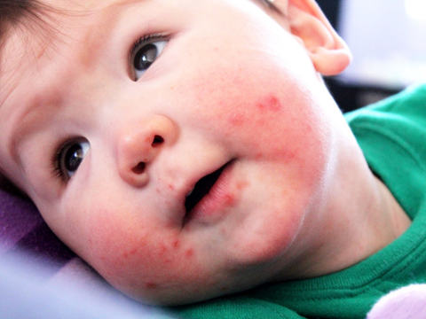 HƯỚNG DẪN NHẬN BIẾT VÀ XỬ LÝ BỆNH TAY CHÂN MIỆNG: CÁCH PHÒNG NGỪA VÀ CHĂM SÓC TRẺ HIỆU QUẢ