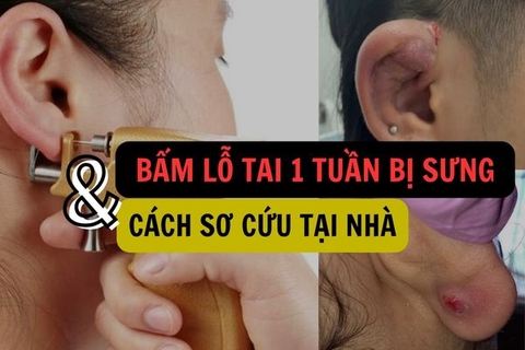 Bấm lỗ tai 1 tuần bị sưng và cách sơ cứu tại nhà an toàn