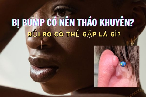 Bị bump có nên tháo khuyên không? Rủi ro mà bạn nên biết