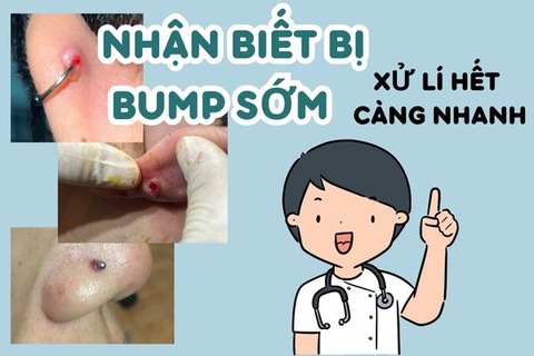 Nhận biết bị bump khi xỏ khuyên sớm xử lí càng nhanh hết