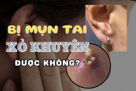 Bị mụn ở thịt tai có xỏ khuyên được không và mẹo bỏ túi