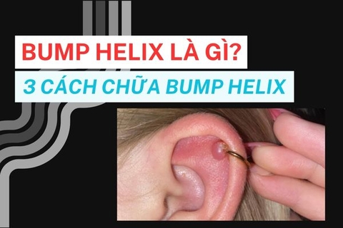 Bump Helix là gì? Cách chữa bump Helix hiệu quả