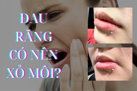 Đau răng xỏ khuyên môi được không? 3 lưu ý bạn nên biết