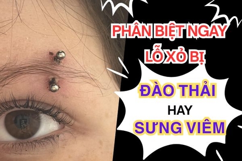 Lỗ xỏ bị đào thải hay sưng viêm? PHÂN BIỆT NGAY ĐỂ KHÔNG HOẢNG LOẠN!