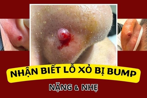 Nhận biết lỗ xỏ khuyên bị bump nặng và bump nhẹ