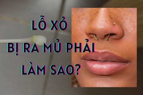 Lỗ xỏ khuyên bị chảy mủ và cách xử lí hiệu quả tại nhà