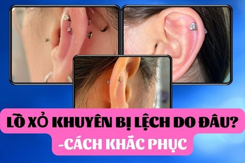 Lỗ xỏ khuyên bị lệch: Làm gì để khắc phục?