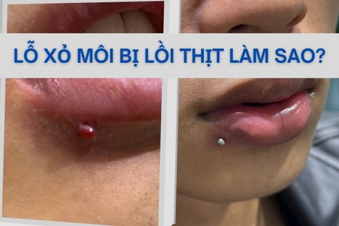 Lỗ xỏ khuyên môi bị lồi thịt: Nguyên nhân & cách khắc phục