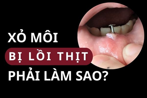 Lỗ xỏ khuyên môi bị lồi thịt: Nguyên nhân & cách khắc phục