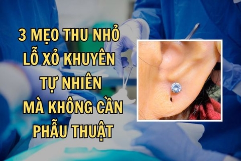 3 cách thu nhỏ lỗ xỏ tai tự nhiên hiệu quả nhất