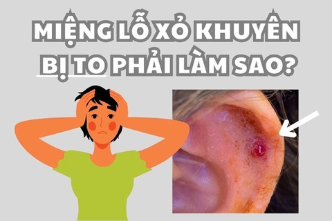 Miệng lỗ xỏ khuyên bị lở có sao không và cách xử lí