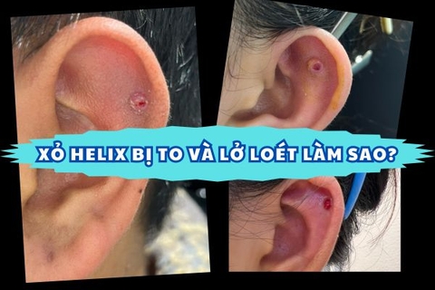 Miệng lỗ xỏ sụn Helix bị to và lở loét phải làm sao?
