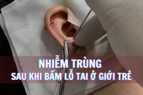 Nhiễm trùng sau khi bấm lỗ tai ở giới trẻ