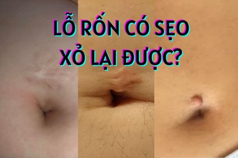 Rốn có sẹo xỏ lại được không? Và 3 lời khuyên